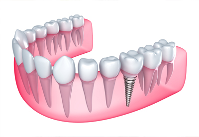 All-on-4 Full Mouth Dental Implants, Florence