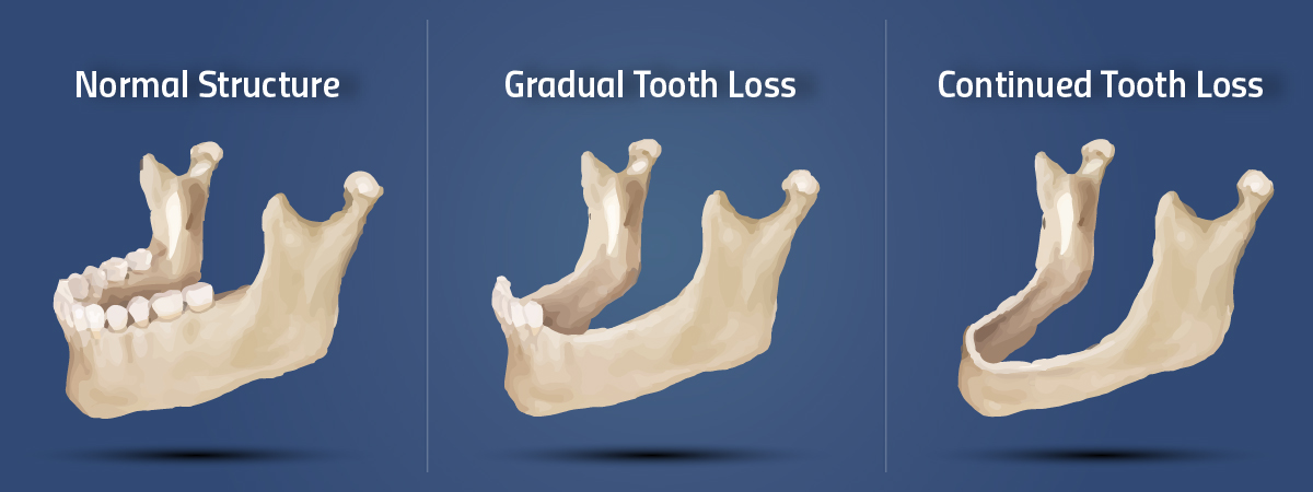 Tooth And Bone Loss Southern Roots Periodontics