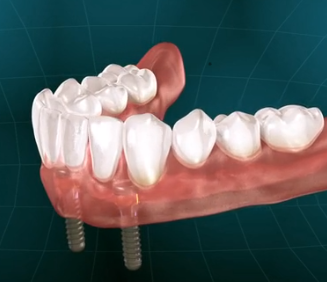 Implants For Dentures