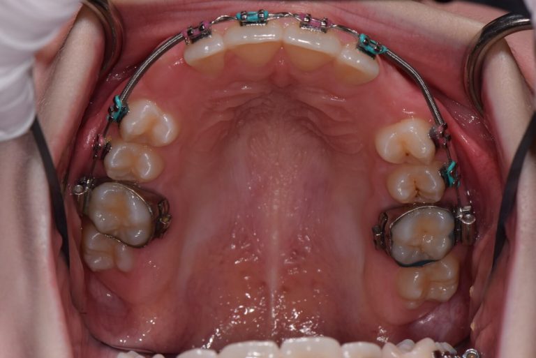 Tooth Exposure for Braces Southern Roots Periodontics