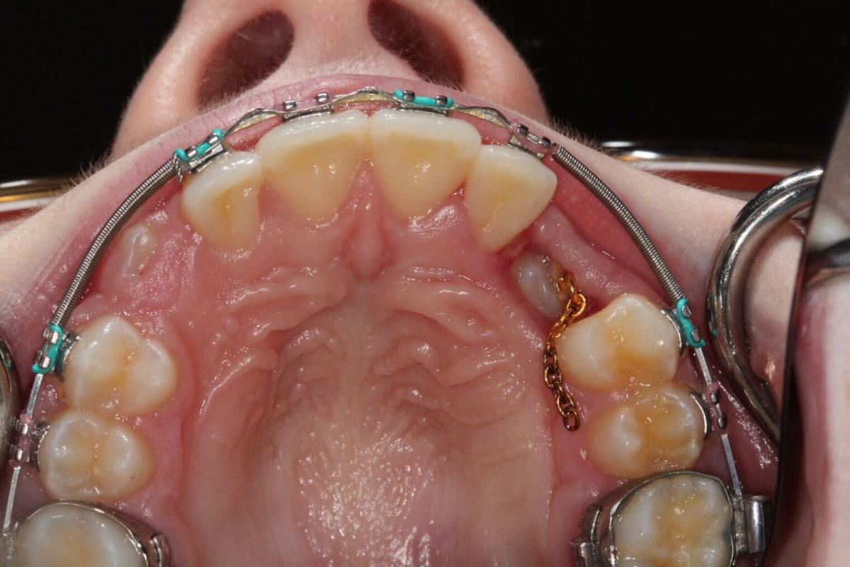 Tooth Exposure for Braces Southern Roots Periodontics