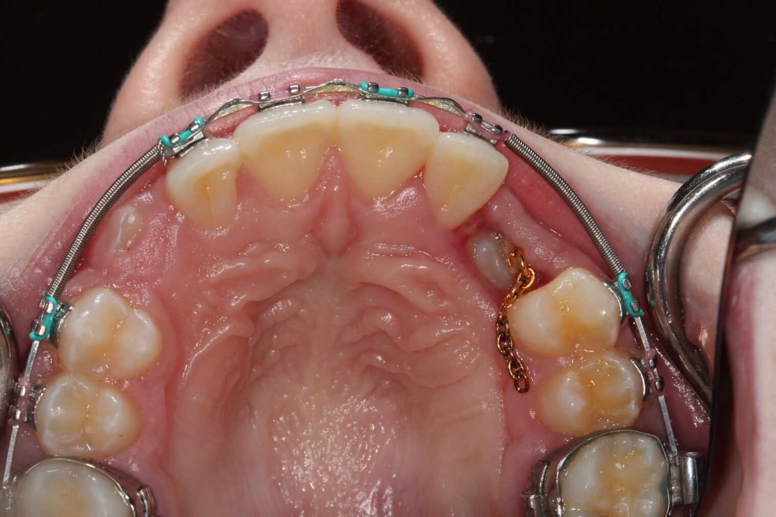 Tooth Exposure for Braces