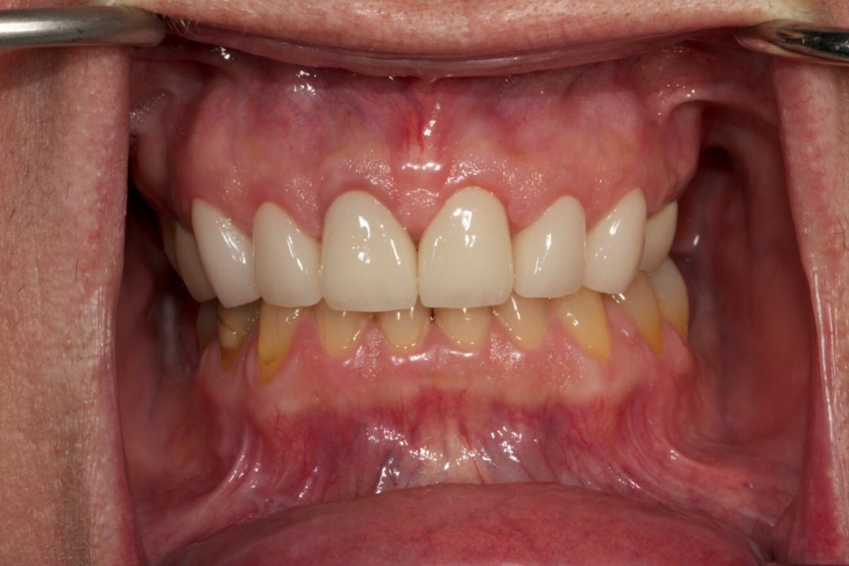 Crown Lengthening - Southern Roots Periodontics